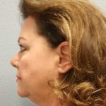Facelift Before & After Patient #11914