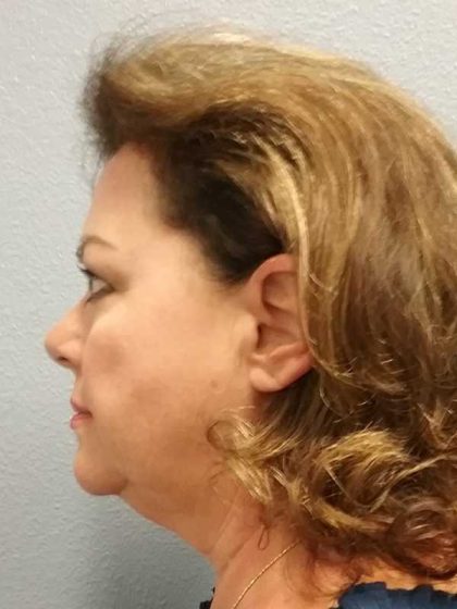 Facelift Before & After Patient #11914