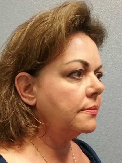 Facelift Before & After Patient #11914