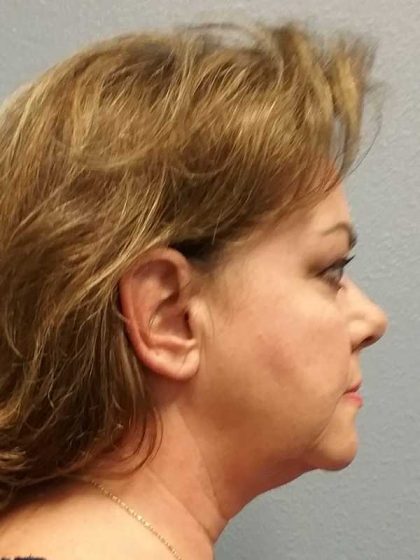 Facelift Before & After Patient #11914