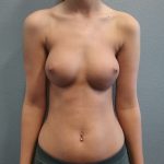 Breast Augmentation Before & After Patient #6100