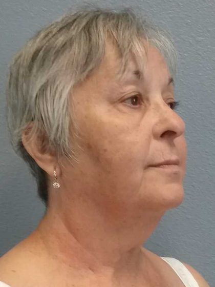 Liposuction of the Neck Before & After Patient #12170