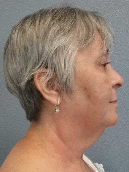 Liposuction of the Neck Before & After Patient #12170