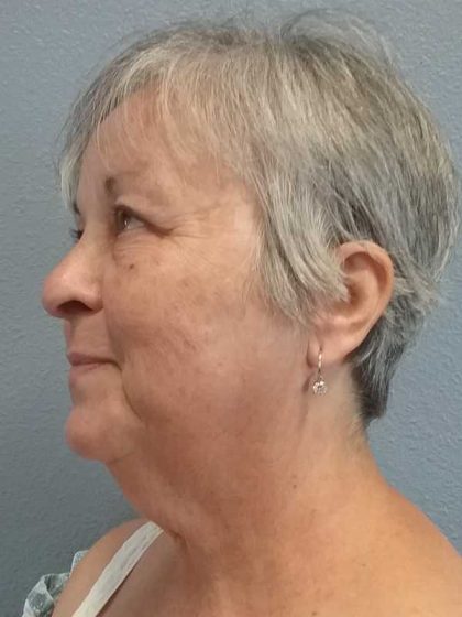 Liposuction of the Neck Before & After Patient #12170