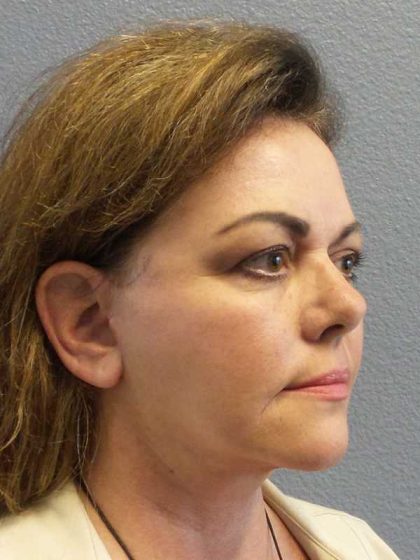 Facelift Before & After Patient #11914