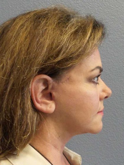 Facelift Before & After Patient #11914