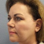 Facelift Before & After Patient #11914