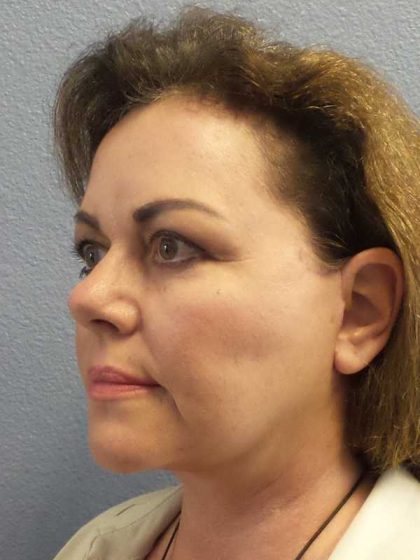 Facelift Before & After Patient #11914
