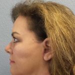 Facelift Before & After Patient #11914