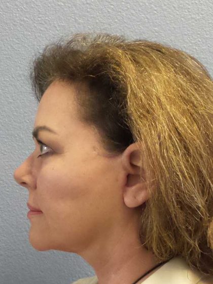Facelift Before & After Patient #11914