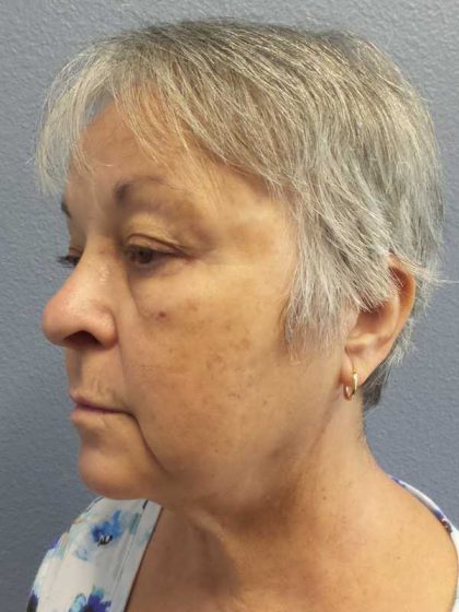 Liposuction of the Neck Before & After Patient #12170