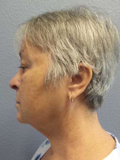Liposuction of the Neck Before & After Patient #12170