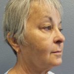 Liposuction of the Neck Before & After Patient #12170
