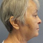 Liposuction of the Neck Before & After Patient #12170