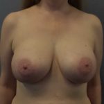 Breast Augmentation Before & After Patient #5375