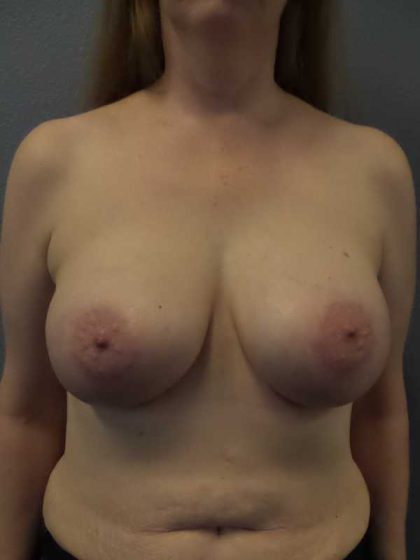 Breast Augmentation Before & After Patient #5375