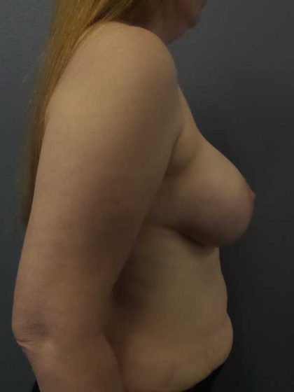 Breast Augmentation Before & After Patient #5375