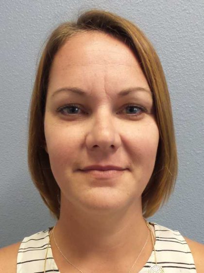 Liposuction of the Neck Before & After Patient #12013