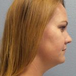 Liposuction of the Neck Before & After Patient #12013