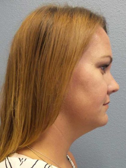 Liposuction of the Neck Before & After Patient #12013