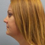 Liposuction of the Neck Before & After Patient #12013