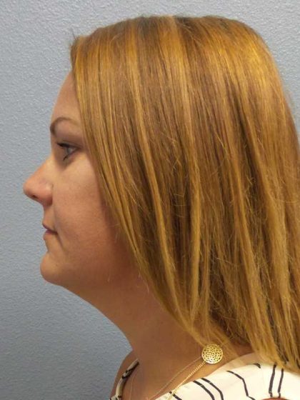 Liposuction of the Neck Before & After Patient #12013
