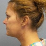 Liposuction of the Neck Before & After Patient #12013