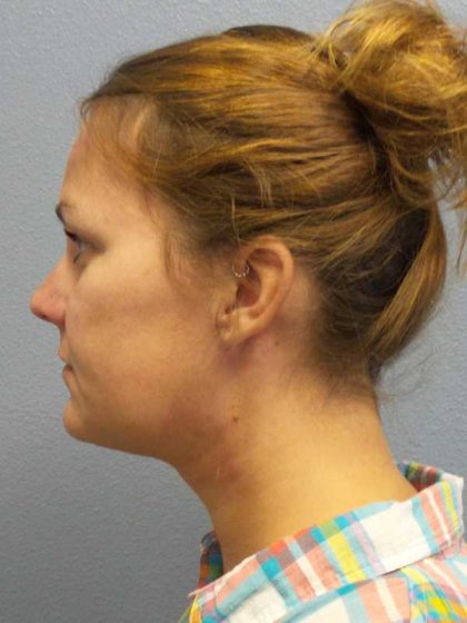 Liposuction of the Neck Before & After Patient #12013