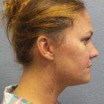 Liposuction of the Neck Before & After Patient #12013