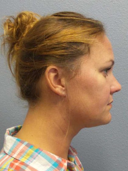 Liposuction of the Neck Before & After Patient #12013