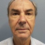 Facelift Before & After Patient #11865