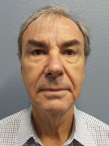 Facelift Before & After Patient #11865