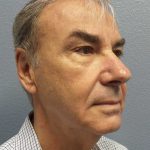 Facelift Before & After Patient #11865