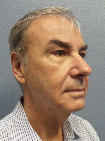 Facelift Before & After Patient #11865