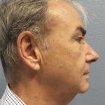 Facelift Before & After Patient #11865
