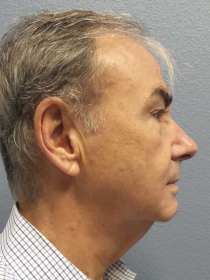 Facelift Before & After Patient #11865