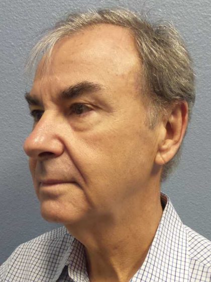 Facelift Before & After Patient #11865