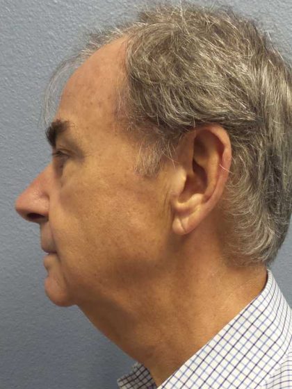 Facelift Before & After Patient #11865