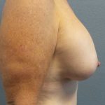 Mastopexy (Breast Lift) Before & After Patient #12235