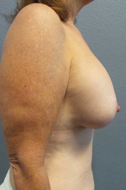 Mastopexy (Breast Lift) Before & After Patient #12235