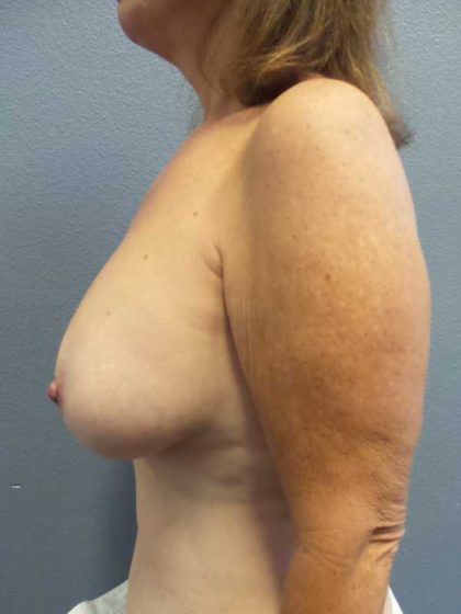 Mastopexy (Breast Lift) Before & After Patient #12235