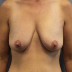 Breast Lift with Implant (Augmentation Mastopexy) Before & After Patient #11251