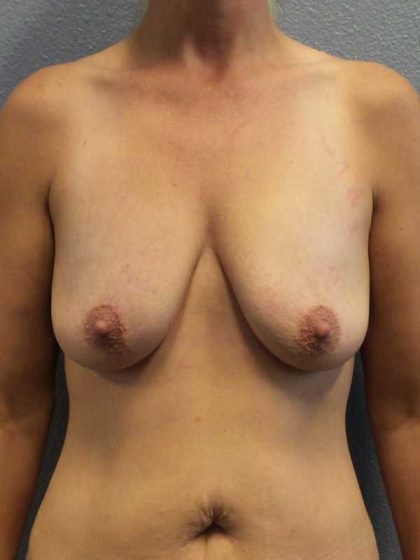 Breast Lift with Implant (Augmentation Mastopexy) Before & After Patient #11251
