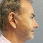 Facelift Before & After Patient #11865