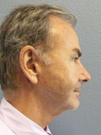 Facelift Before & After Patient #11865