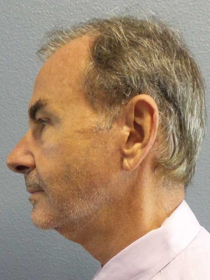 Facelift Before & After Patient #11865