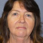 Facelift Before & After Patient #11820