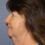 Facelift Before & After Patient #11820