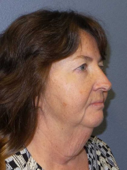 Facelift Before & After Patient #11820