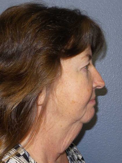 Facelift Before & After Patient #11820